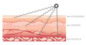 Does microcurrent therapy work?